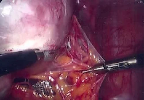 The adhesions are divided to reveal to left ovarian cyst. The cyst is then removed