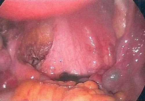 The area on the left demonstrates closure of the rectum following excision of endometriosis.