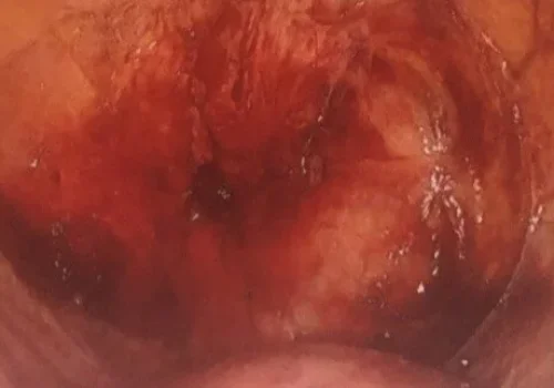 The bladder endometriosis has been excised.