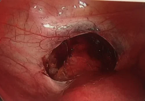 The bladder has been reflected to allow for accurate placement of the cervical cerclage.