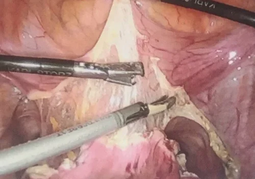 The bladder is carefully reflected out of the surgical field.