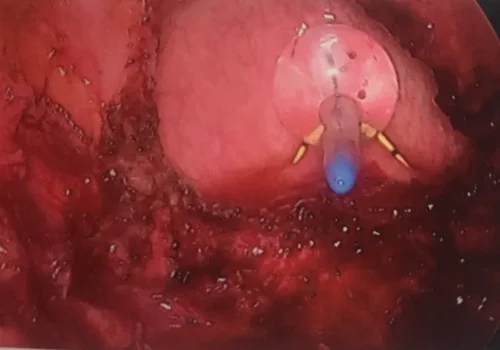 The bladder is entered as part of the procedure to ensure complete removal of the nodule. The urinary catheter and ureteric stents are seen.