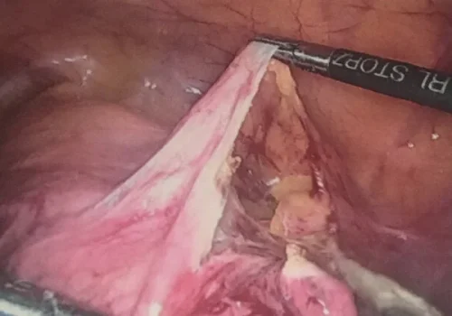 The bladder is reflected clear of the surgical field.
