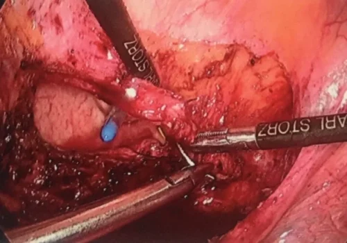 The bladder is sutured laparoscopically.