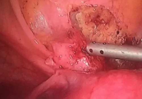 The bladder nodule is dissected laparoscopically. The bladder is mobilised.