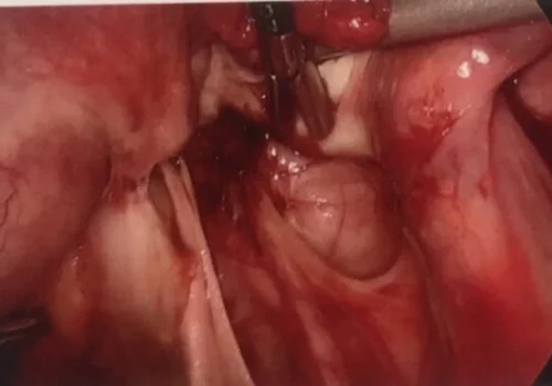 The bowel adhesions are divided and normal right ovary is mobilised. The right ureter is dissected out.