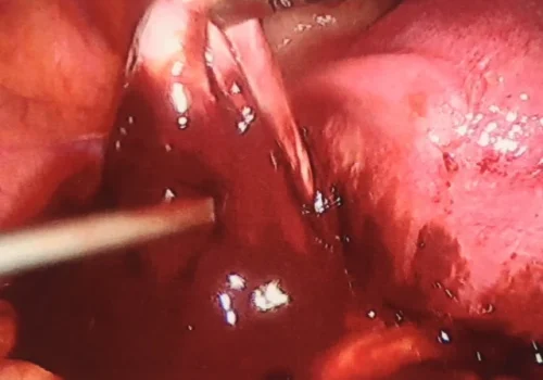 The bowel adhesions are divided carefully by sharp dissection. These cysts are called chocoloate cysts because they contain chocolate -like fluid.