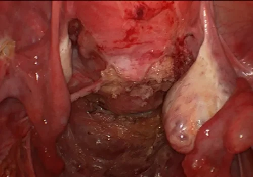 The bowel has been mobilised and the area of endometriosis removed. A normal right ovary is seen.