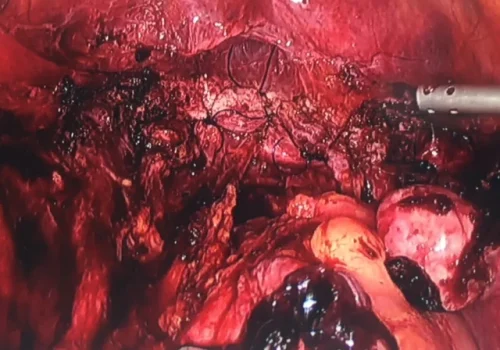 The bowel has been mobilised from the posterior cervix and uterus