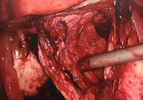 The bowel has been mobilised. The right ovary is mobilised and the endometrioma wall is stripped. The same procedure is performed on the left ovary.