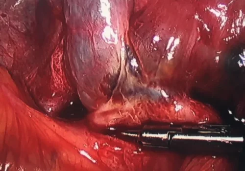 The bowel is adherent to the left ovary and tube at the pelvic brim.