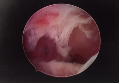 The cavity is gradually opened as the adhesions are divided