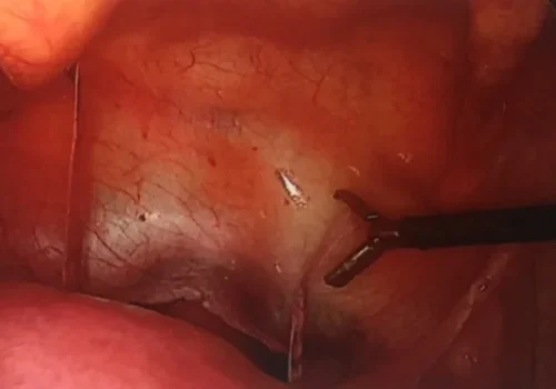 The cervical cerclage is placed on either side of the cervix.