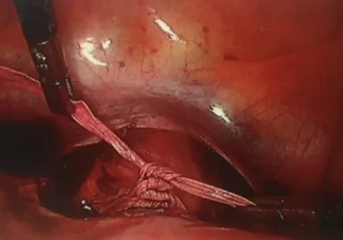The cervical cerclage is tied in front of the cervix.