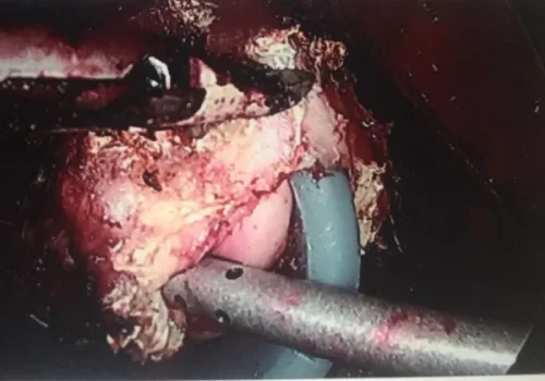 The cervix is detached from the vaginal vault and then removed.