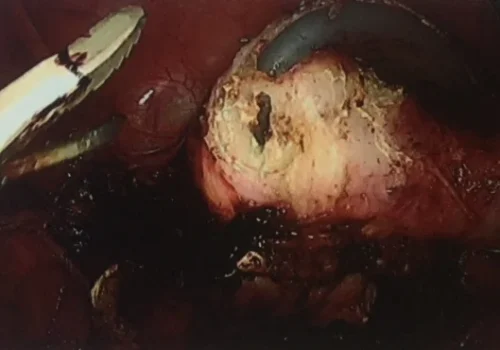 The colpotomy is continued. The uterus and cervix are then removed through the vagina.