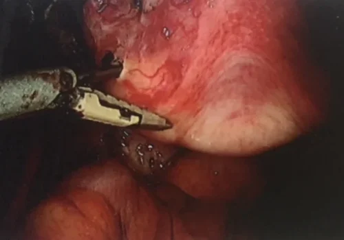 The colpotomy is performed to detach the uterus and cervix from the vagina.