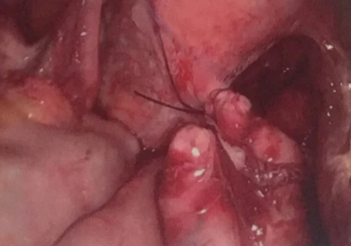 The connection to the uterus is tied off.