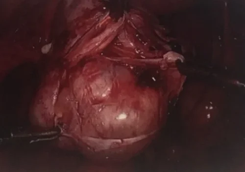 The contents of the dermoid cyst - several compartments.