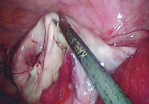 The cyst has been removed from the ovary