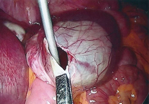 The cyst is carefully decompressed to avoid spillage.