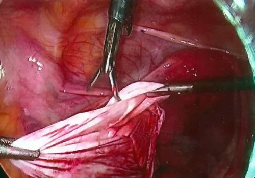 The cyst is decompressed and stripped out.