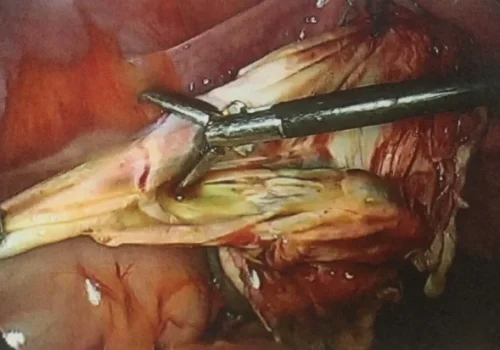 The cyst is stripped out and normal ovarian tissue is preserved.