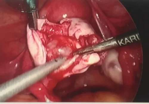 The dermoid cyst is removed and the normal ovarian tissue remains.