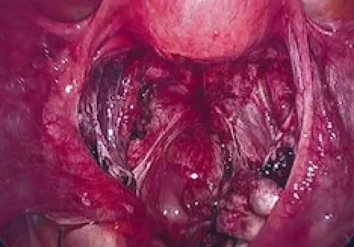 The end of the operation showing two normal ovaries – ongoing healing will continue
