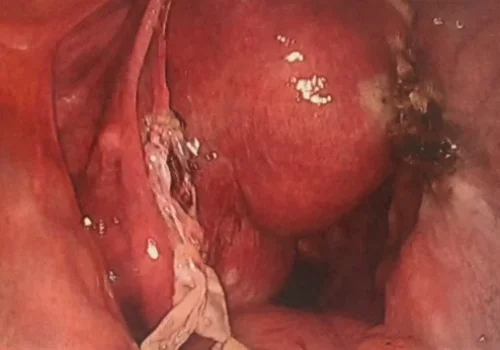 The end of the procedure. The left ovary is seen. The right ovary has been removed.