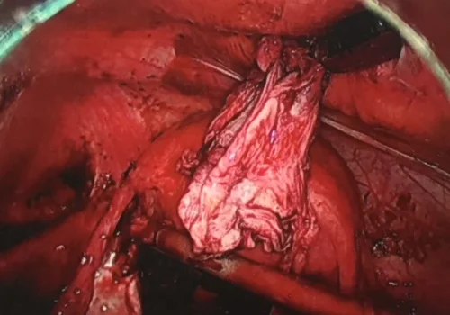The endometrioma wall seen next to the uterus.
