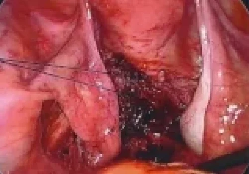 The endometriosis extended through to the vagina and a small area of the vagina is removed. This area is closed laparoscopically