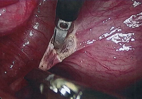 The endometriosis is being excised from Left Pelvic Side Wall and Left Uterosacral Ligament