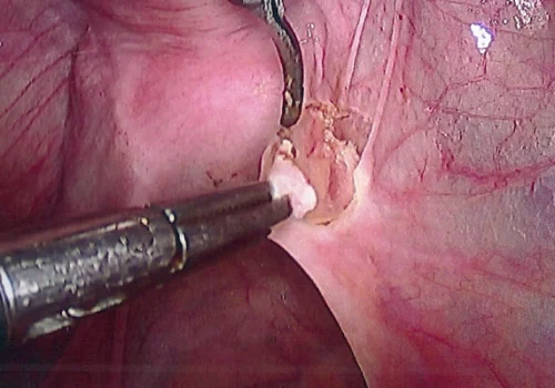 The endometriosis is excised