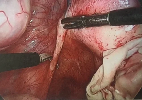 The endometriosis of the left Utero-sacral ligament is excised.