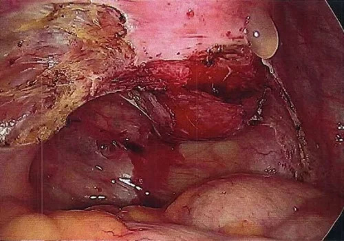 The endometriosis over the posterior cervix and both pelvic side walls has been excised