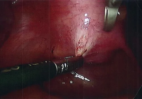 The endometriosis over the posterior cervix is excised