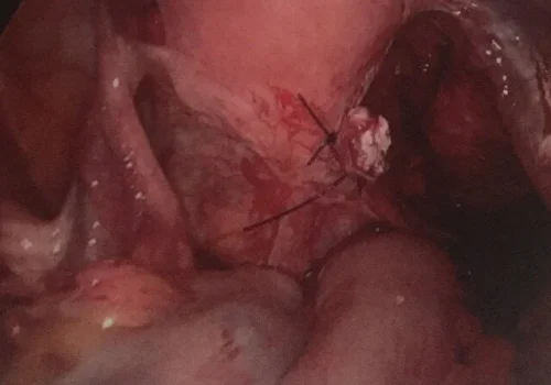 The fibroid has been removed.