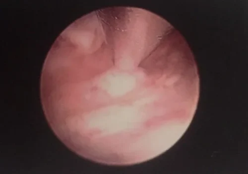 The fibroid has been resected.