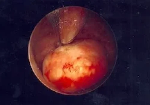 The fibroid is being removed