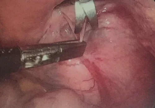 The fibroid is carefully dissected out and mobilised.