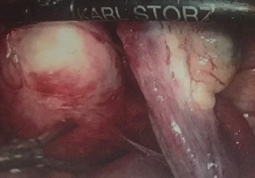 The fibroid is carefully dissected out and mobilised..