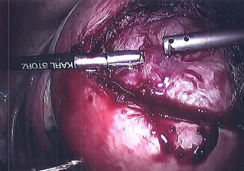 The fibroid is dissected out of the uterus