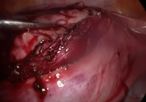 The fibroid is dissected out of the uterus. The white fibroid is on the left. The normal uterine muscle is on the right
