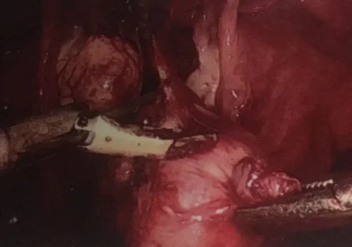 The fibroid is removed.