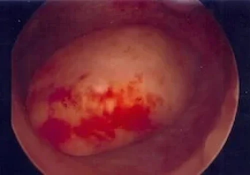 The fibroid is seen in the cavity of the uterus