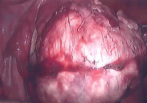 The fibroid is shelled out of its capsule
