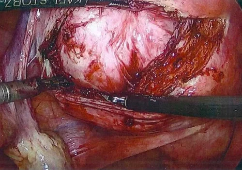 The fibroid is shelled out of the uterus