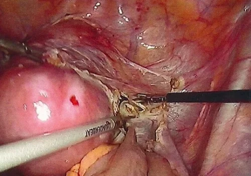 The hysterectomy proceeds with the usual technique