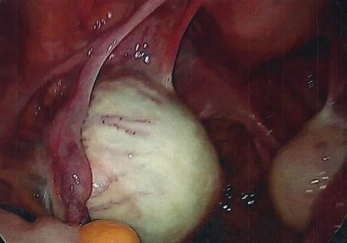 The laparoscopic view of the large left Ovarian Dermoid Cyst.
